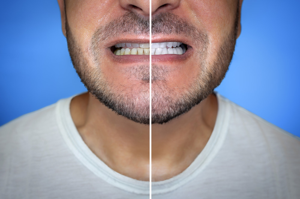 close-up-of-a-man-s-mouth-before-and-after-teeth-2025-02-24-23-34-57-utc (1)