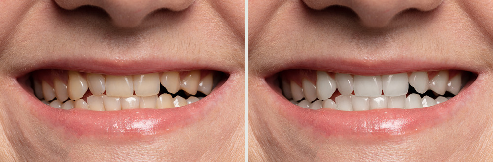 teeth-whitening-before-and-after-close-up-2025-02-12-18-38-16-utc (1)