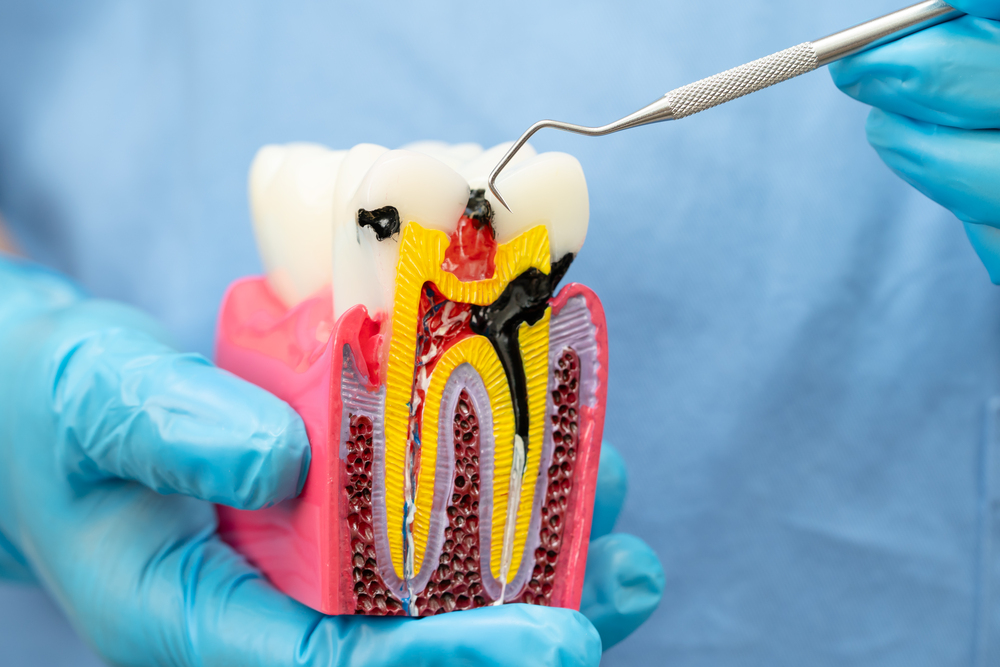 Model of root canal treatment