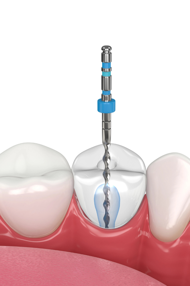 Illustration of root canal procedure