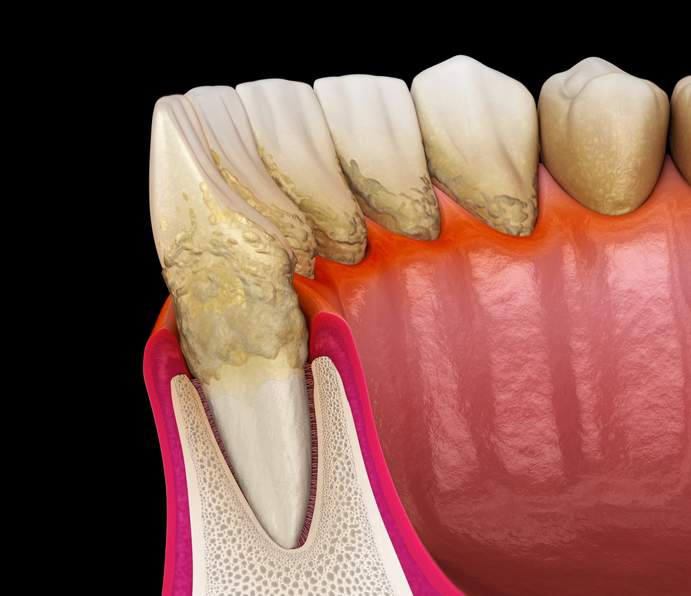Illustration of periodontal problem 
