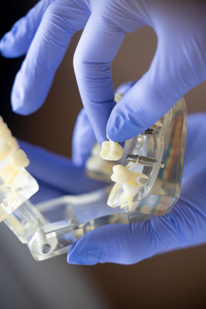 Model of a dental implant in North York