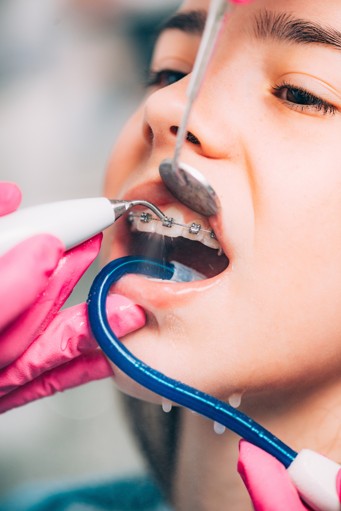 Teen during dental cleaning in North York